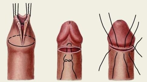 Comment se déroule la chirurgie plastique du pénis 